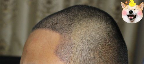 -大麦微针植发丨全国连锁