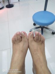 -派恩宜灰指甲鸡眼嵌甲手足癣