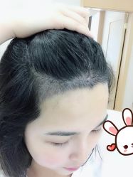 -大麦微针植发丨全国连锁