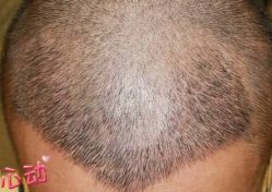 -大麦微针植发丨全国连锁