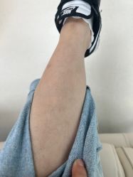 -薇兰专业脱毛连锁机构