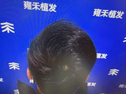 -雍禾植发全国连锁