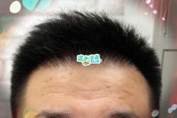 -大麦微针植发全国连锁