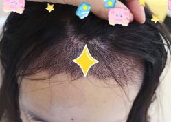 -大麦微针植发全国连锁