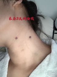 -大麦微针植发全国连锁