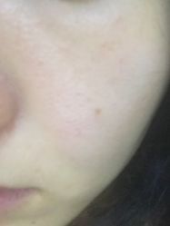 -苗医生草本科技祛痘