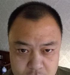 -碧莲盛·不剃发植发