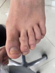 -德哥灰指甲脚气甲沟炎跖疣护理