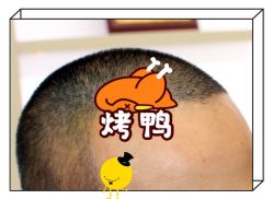 -大麦微针植发全国连锁