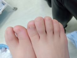 -EPAI·灰指甲·甲沟炎·嵌甲护理
