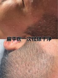 -清疣美疣·痣·斑净肤中心