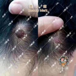 -美人痣全国连锁