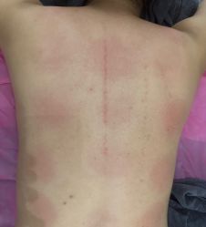-莲芸拔罐减肥
