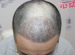 -大麦微针植发丨全国连锁