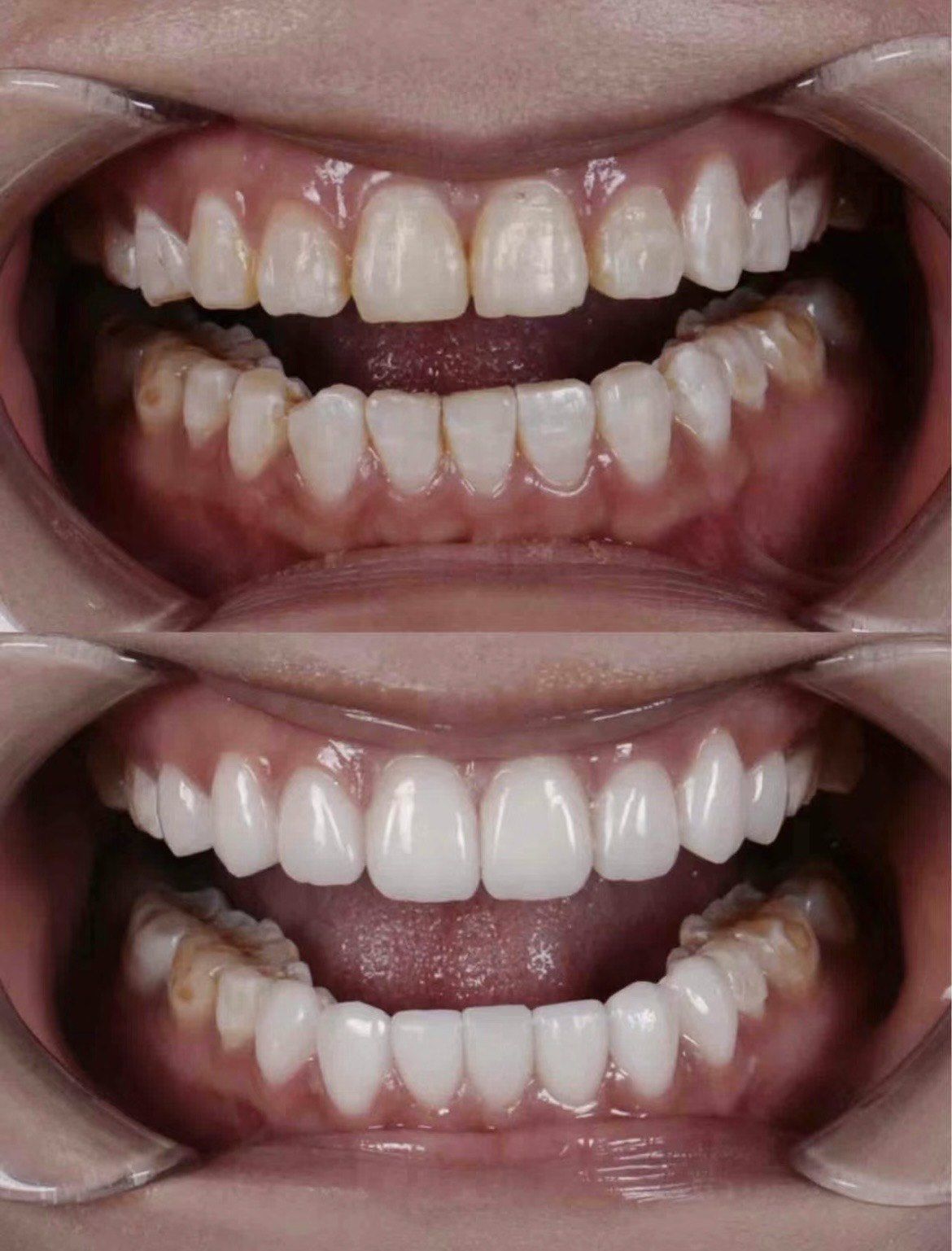 上海牙齿贴面#上海牙齿贴面医生赵高清 #上海鑫沐颜面部美学口腔 
n