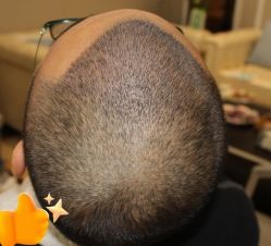 -大麦微针植发丨全国连锁