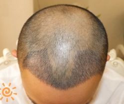 -大麦微针植发丨全国连锁