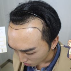 -大麦微针植发丨全国连锁