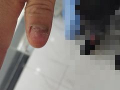 -Andrew指甲专科灰指甲·甲沟炎矫正·3D步态矫形鞋垫定制(浦三路店)