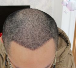 -大麦微针植发丨全国连锁