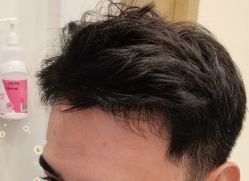 -大麦微针植发丨全国连锁