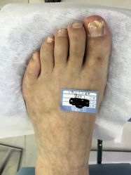 -派恩宜灰指甲鸡眼嵌甲手足癣