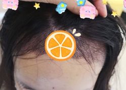 -大麦微针植发全国连锁