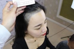 -大麦微针植发丨全国连锁