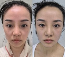 -海涛医疗美容·面部抗衰·注射美鼻