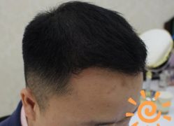 -大麦微针植发丨全国连锁