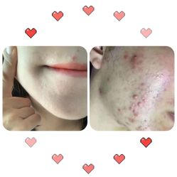 -苗方清颜痘肌研究所