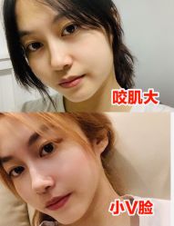 体验前-More摩尔医美の注射线雕光电中心