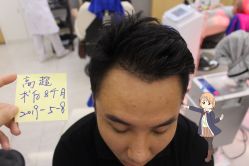 -大麦微针植发丨全国连锁