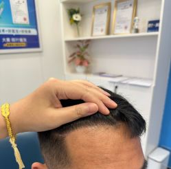 -大麦微针植发全国连锁