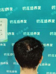 -碧莲盛·不剃发植发