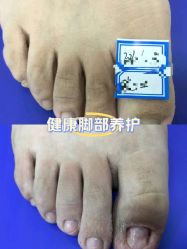 -德哥灰指甲脚气甲沟炎跖疣护理