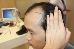 -大麦微针植发丨全国连锁