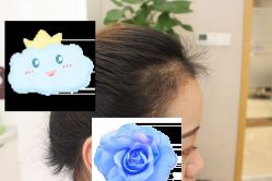 -大麦微针植发丨全国连锁