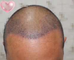 -大麦微针植发丨全国连锁