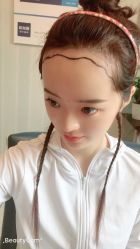 -大麦微针植发丨全国连锁