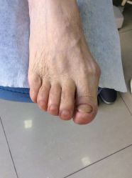 -德哥灰指甲脚气甲沟炎跖疣护理