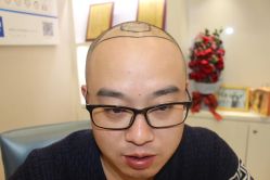 点击看大图 -大麦微针植发丨全国连锁