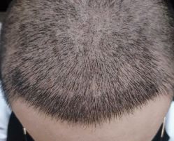 -大麦微针植发全国连锁