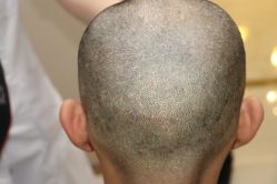 点击看大图 -大麦微针植发丨全国连锁