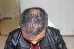 -大麦微针植发丨全国连锁