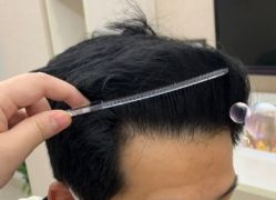 -大麦微针植发丨全国连锁