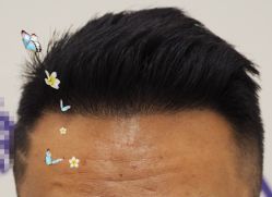 -大麦微针植发全国连锁