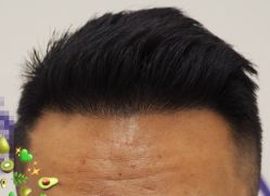 -大麦微针植发全国连锁