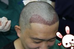 点击看大图 -大麦微针植发丨全国连锁