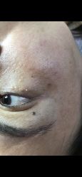 -美丽人生祛斑扁平疣汗管瘤中心